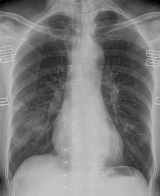 Portable chest X-ray in coronavirus disease-19 (COVID-19): A pictorial  review - ScienceDirect