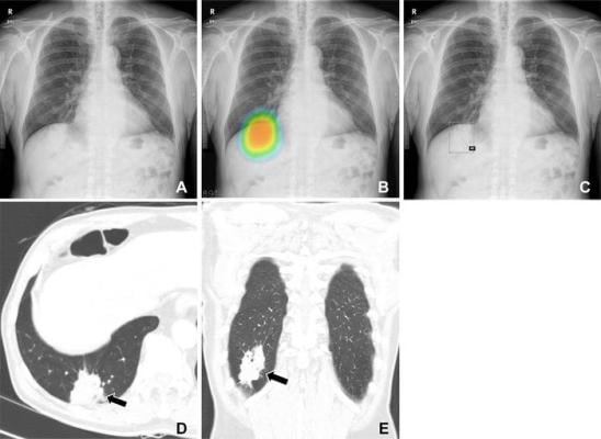 Assistance from an artificial intelligence (AI) algorithm with high diagnostic accuracy improved radiologist performance in detecting lung cancers on chest X-rays and increased human acceptance of AI suggestions, according to a study published in Radiology, a journal of the Radiological Society of North America (RSNA). 