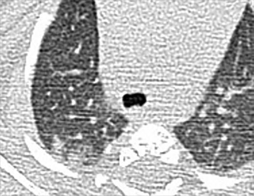 #COVID19 #Coronavirus #2019nCoV #Wuhanvirus #SARScov2 Chest CT findings of pediatric patients with COVID-19 on transaxial images. (a) Male, 2 months old, 2 days after symptom onset. Patchy ground-glass opacities GGO in the right lower lobe