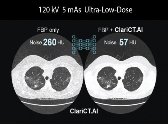 ClariPi Gets FDA Clearance for AI-powered CT Image Denoising Solution