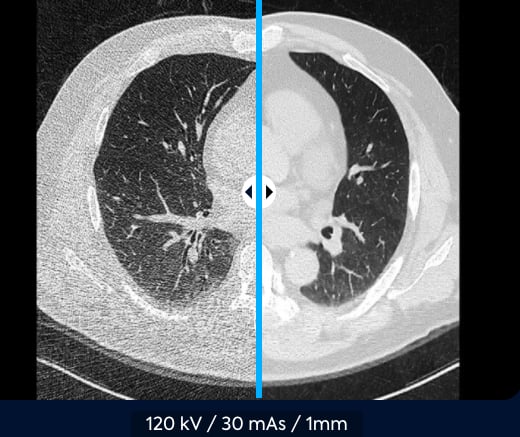 ClariCT.AI helps improve the image quality of low-dose CT scans. This image shows before and after denoising imaging. 