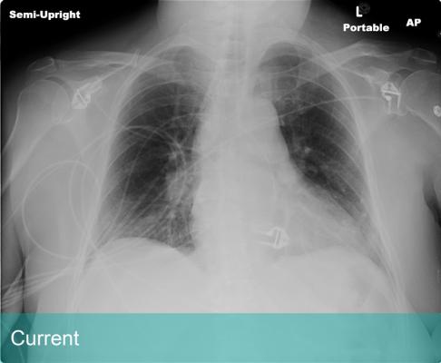 The company’s ClearRead Xray Confirm (Enhanced) and ClearRead CT – breakthrough lung nodule detection applications­ – have received clearance for sale in Australia
