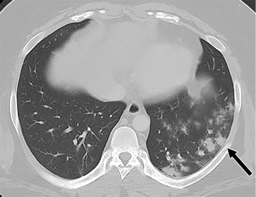 A 26-year-old man with history of diabetes and hypertension presented with 7 days of fever, chills, nausea, intractable vomiting, diarrhea and generalized weakness, but no specific upper or lower respiratory symptoms aside from mild shortness of breath.