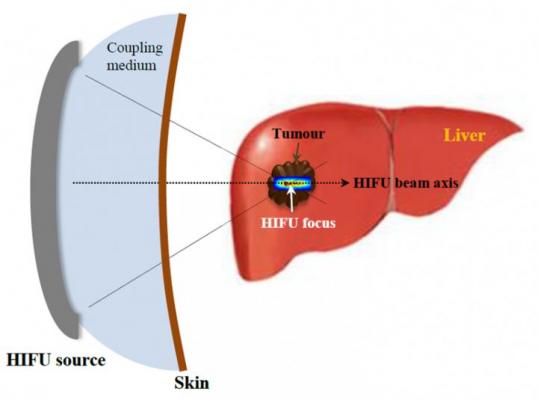 Conceptual diagram of bio-organizational crushing technology based on high-intensity concentric ultrasonography. Image courtesy of Korea Institue of Science and Technology(KIST)