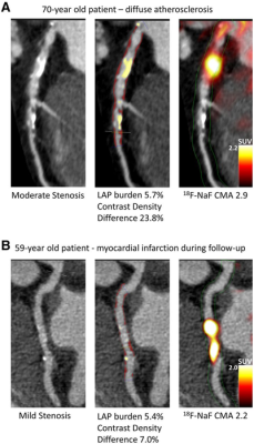 Case examples of quantitative plaque analysis on coronary CT angiography and 18F-NaF PET in patients with established coronary artery disease. Hybrid CT angiography and 18F-NaF PET of coronary arteries. (A) A 70-y-old male, who presented with diffused largely noncalcified disease (middle panel in red) in the LAD and demonstrated increased 18F-NaF uptake in the LAD on PET. (B) A 59-y-old male with mild LCX atherosclerosis, who presented with a high noncalcified plaque burden (middle panel in red) on CT angio