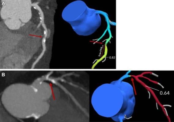 An advanced CT test can identify individuals with stable angina at a reduced risk of three-year adverse outcomes despite their having a high coronary artery calcium score 