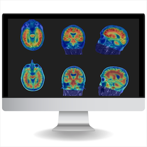 FDA Clears Cortechs.ai's NeuroQuant PET 