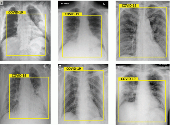 Results of chest X-Rays, detected as Covid-19.