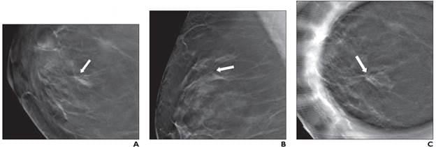 49-Year-Old Woman Presenting for Screening Mammography, Revealing Right Breast Architectural Distortion: (A) Right craniocaudal, (B) mediolateral oblique, (C) spot compression tomosynthesis images show architectural distortion in right breast at 12 o’clock position (arrows). No sonographic correlate identified. Tomosynthesis-guided needle biopsy yielded radial scar—not upgraded at surgery.