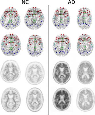 dementia imaging, clinical trial, MRI systems, RSNA 2014, alzheimer's 