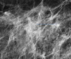 dense breast tissue