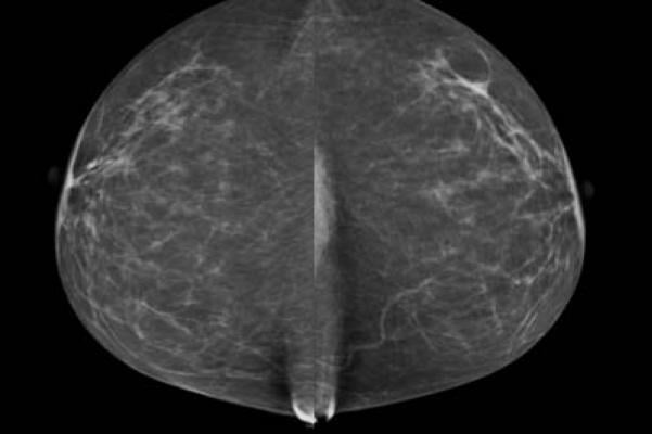 breast density, infertility treatments, breast cancer risk, Karolinska Institutet