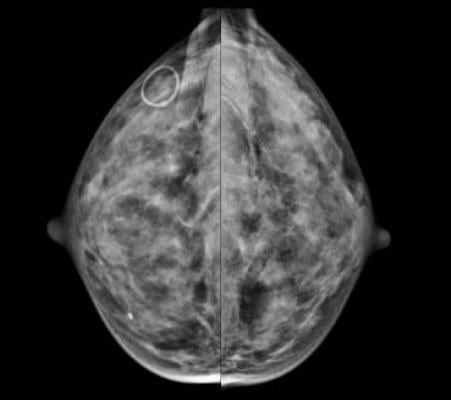 dense breast tissue, contralateral breast cancer, MD Anderson study, Cancer journal