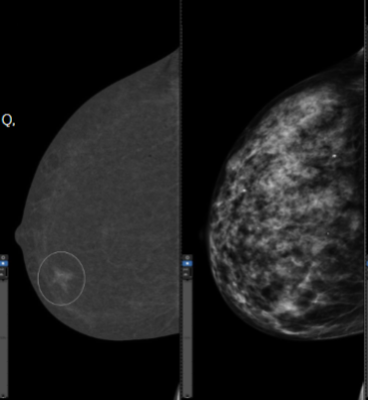 Left: Recombined image of the CEM exam showing iodine uptake. Right: Standard digital mammogram. 