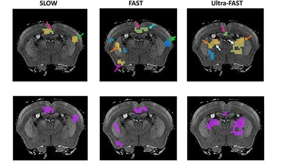 New MRI Technique Captures Brain Changes in Near-real Time