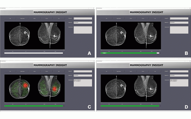Interface of the artificial intelligence–based diagnostic system. Images show interface appearance when (A) loading a new mammogram, (B) performing the image evaluation, (C) displaying the results of the image evaluation via a heatmap, and (D) displaying the results of the image evaluation with the heatmap turned off.