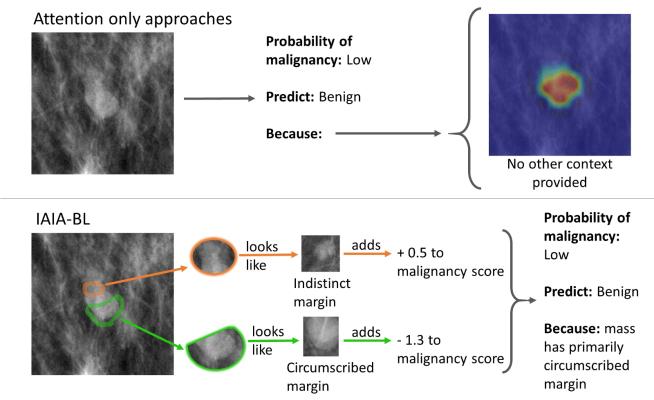 Most AI for spotting pre-cancerous lesions in mammography scans don’t reveal any of their decision-making process (top). If they do, it’s often a saliency map (middle) that only tells doctors where they’re looking. A new AI platform (bottom) not only tells doctors where it’s looking, but which past experiences its using to draw its conclusions.