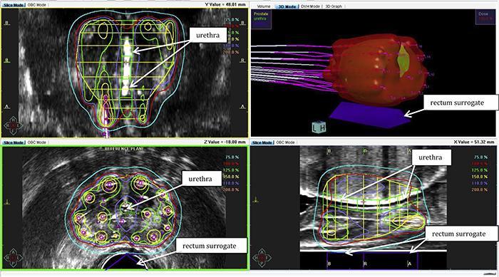 Shorter Radiotherapy Courses Safe and Effective for Prostate Cancer