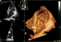 ASE Study Shows Echocardiography Benefits for Cancer Patients 