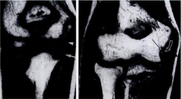Elbow images. In image on the left (10-year-old boy), growth plate has not yet fused. On the right (15-year-old boy), growth plate has fused. (Courtesy of Radiology)