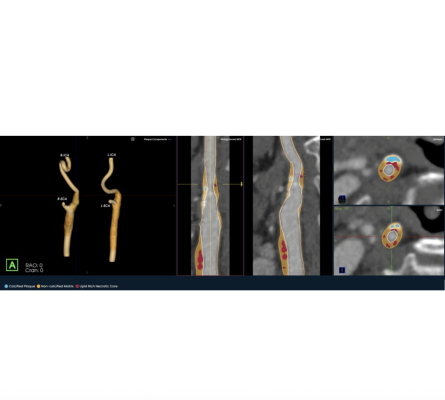 Image Analysis Software for the Carotid Arteries Now Available
