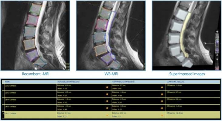 Esaote Launches Q-Spine Analysis Software