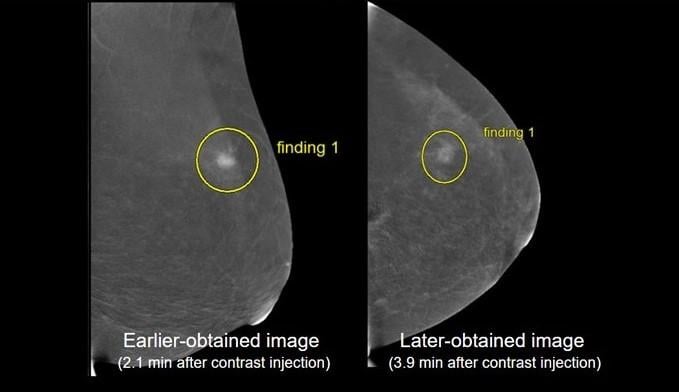 Findings from a Scientific Online Poster presented during the 2023 ARRS Annual Meeting at the Hawaiian Convention Center suggest there is institutional variability in both projection order and image acquisition timing for contrast-enhanced mammography (CEM) protocol 