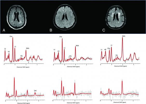 1H-MR spectra of 3 consecutive patients with COVID-19. Upper row: Axial FLAIR images at the corona radiata level show representative MRS voxels (black squares) from sampled periventricular regions. Lower row: Corresponding spectrum (black) and LCModel fit (red) from each patient acquired at TE = 30 ms (upper row) and TE = 288 ms (lower row). A, A patient with COVID-19-associated multifocal necrotizing leukoencephalopathy shows diffuse patchy WM lesions with markedly increased Cho and decreased NAA, as well 