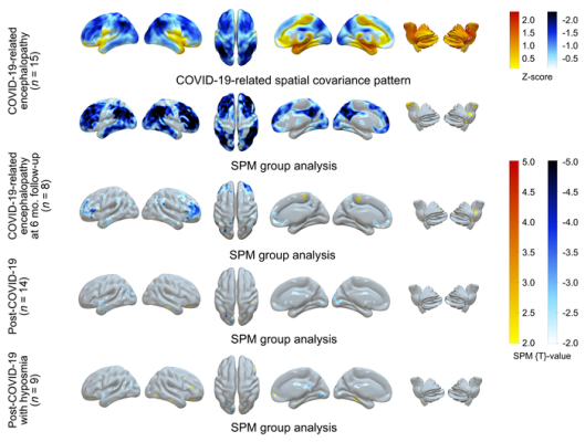 F-18 FDG PET in COVID-19–related CNS disorders: Principal components analysis of spatial covariance pattern (first row) and statistical parametric mapping analysis of metabolic group differences (second to fifth rows) in patients with COVID-19–related encephalopathy, patients with post-COVID-19 syndrome, and patients with post-COVID-19 syndrome and hyposmia compared to healthy controls (n=13). Image Created by PT Meyer, S Hellwig, G Blazhenets and JA Hosp, Medical Center – University of Freiburg, Germany.