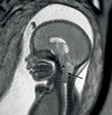 MRI, fetal brain abnormalities, 20-week ultrasound scan, improved diagnosis, The Lancet