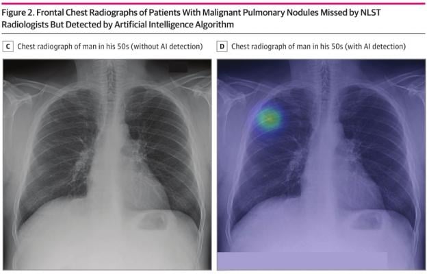Study conducted by medical AI startup Lunit and Massachusetts General Hospital, published in JAMA Network Open - When used as a second reader, the AI algorithm may help detect lung cancer