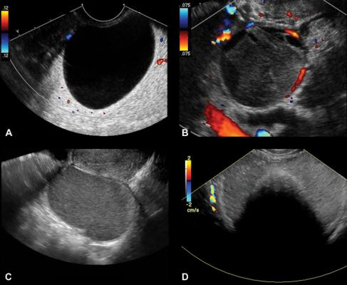 Representative transvaginal US images of classic lesions; color Doppler blood flow with color bar signifies direction of flow. (A) Transverse color Doppler image of right adnexa depicts an anechoic cyst with no internal elements or Doppler flow, compatible with a simple cyst. (B) Transverse color Doppler image of left adnexa depicts a cystic lesion with retractile clot and no Doppler flow, compatible with a hemorrhagic cyst. (C) Sagittal gray-scale image of left adnexa depicts a cystic lesion with homogeneo