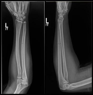 Up to one-third of women who sustain a fracture to the ulna bone of the forearm may be victims of intimate partner violence