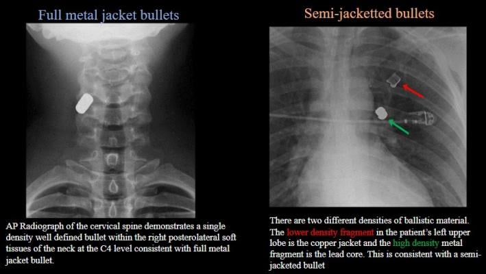 Left: AP radiography of cervical spine demonstrates single-density well-defined bullet within right posterolateral soft tissues of neck at C4 level—consistent with full metal jacket bullet Right: Two different densities of ballistic material. Lower-density fragment in left upper lobe is copper jacket and high-density metal fragment is lead score—consistent with semi-jacketed bullet.