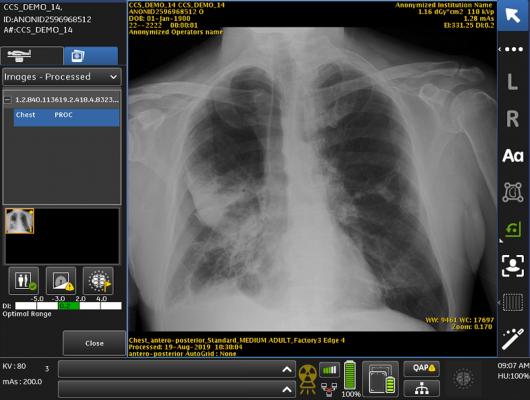 FDA Clears GE Healthcare's Critical Care Suite Chest X-ray AI