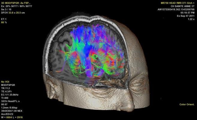 Machine Learning Uncovers New Insights Into Human Brain Through fMRI