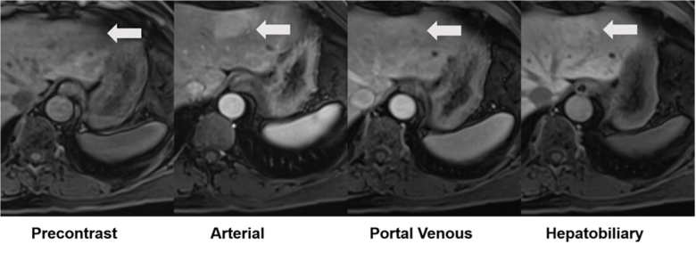 54-year-old with pathologically confirmed inflammatory adenoma in left lobe that underwent evaluation by gadoxetate disodium-enhanced MRI. Axial T1-weighted fat-saturated precontrast image shows isointensity to liver of adenoma (arrow). Axial arterial-phase postcontrast image shows hyperintensity to liver (arrow). Axial portal-venous phase postcontrast image shows hyperintensity to liver (arrow). Axial hepatobiliary-phase postcontrast image shows hyperintensity to liver (arrow). Hepatobiliary-phase liver-to