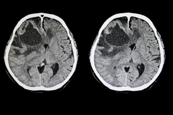 Above a certain size, individual brain metastases are often surgically removed with the help of microsurgical resection. In stereotactic radiosurgery (SRS), in contrast, they are usually treated with a single high-dose targeted radiation using cobalt-60-gamma radiation sources. 