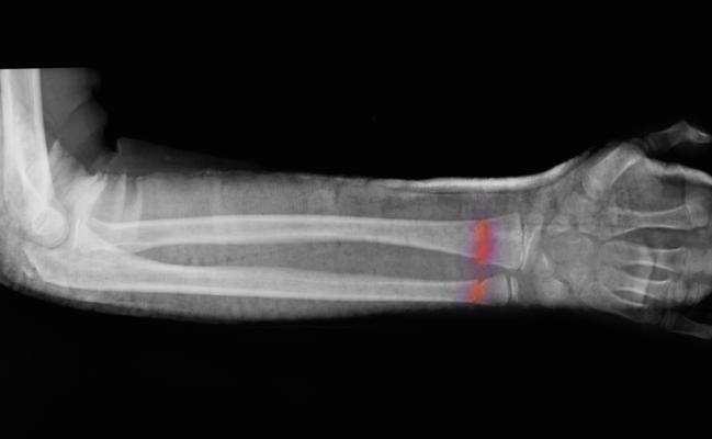 Artificial intelligence (AI) is an effective tool for fracture detection that has potential to aid clinicians in busy emergency departments, according to a study in Radiology.