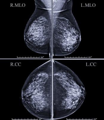 The Breast Imaging and Reporting System (BI-RADS) was established by the American College of Radiology to help classify findings on mammography. Findings are classified based on the risk of breast cancer, with a BI-RADS 2 lesion being benign, or not cancerous, and BI-RADS 6 representing a lesion that is biopsy-proven to be malignant.