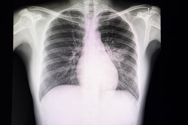 New Research Finds Chest X Ray Not Reliable Diagnostic Tool For Covid 19 Imaging Technology News