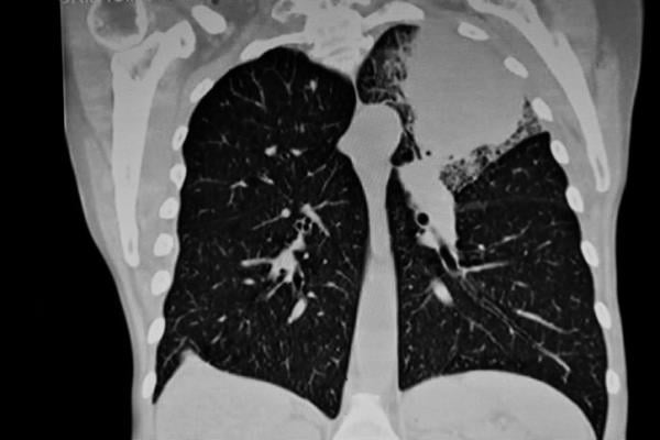 Swiftness is essential when treating lung cancer, the second most common type of cancer in the U.S. and the country's leading cause of cancer deaths. 