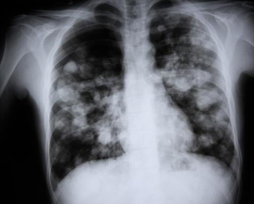 Diagnosis of community acquired pneumonia in children usually involves X-rays, despite recommendations to limit their use by professional societies. In efforts to reduce radiation exposure from x-rays in children and reinforce guideline compliance, researchers from Ann & Robert H. Lurie Children’s Hospital of Chicago and colleagues developed a simple diagnostic model that accurately predicts whether patients are at high risk or low risk for community acquired pneumonia, eliminating the need for x-ray