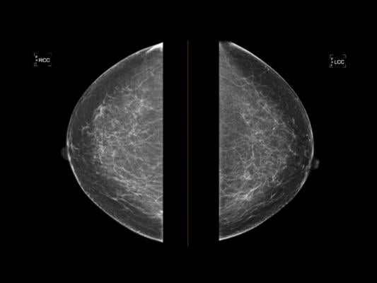 Onsite Women’s Health, Whiterabbit and Washington University in St. Louis Join Forces to Explore Breast Density and Implications for Breast Cancer Risk 