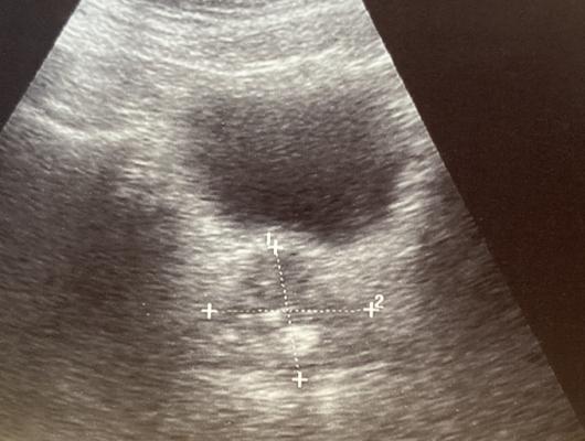 The "US Prostate Cancer Nuclear Medicine Diagnostics Market to 2027 - Country Analysis and Forecast by Type; PET Product" report has been added to ResearchAndMarkets.com's offering. The prostate cancer nuclear medicine diagnostics market in the US was valued at $194.47M in 2019 and is expected to grow at a CAGR of 10.6% from 2020 to 2027 to reach $431.76M by 2027.