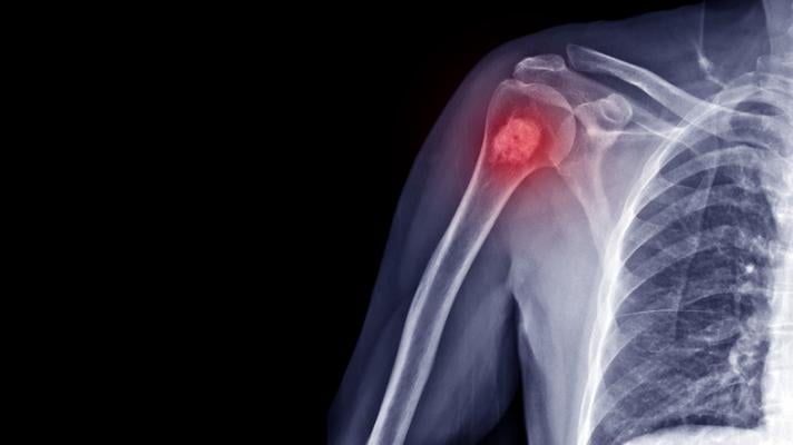 Benign bone tumors may be present in nearly 20 percent of healthy children, based on a review of historical radiographs in The Journal of Bone & Joint Surgery. The journal is published in the Lippincott portfolio in partnership with Wolters Kluwer.
