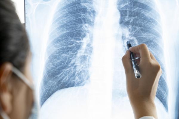  Disease of the small airways in the lungs is a potential long-lasting effect of COVID-19, according to a new study published in the journal Radiology. 
