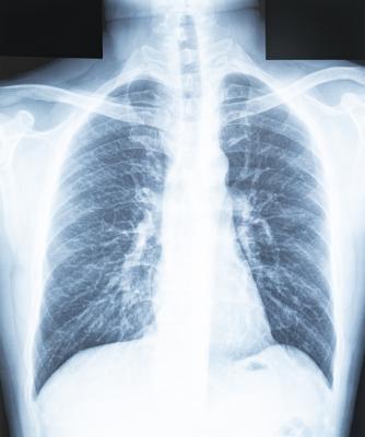 In a study of more than 2,000 chest X-rays, radiologists outperformed AI in accurately identifying the presence and absence of three common lung diseases 