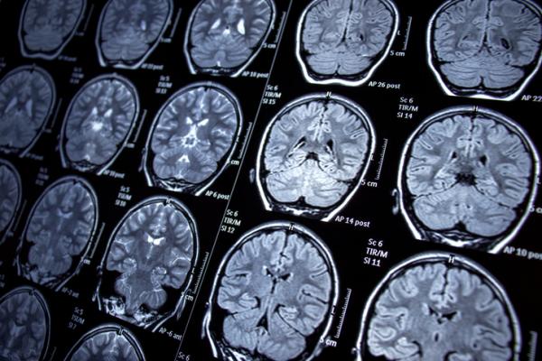 Researchers from the School of Biomedical Engineering & Imaging Sciences at King's College London have automated brain MRI image labeling, needed to teach machine learning image recognition models, by deriving important labels from radiology reports and accurately assigning them to the corresponding MRI examinations