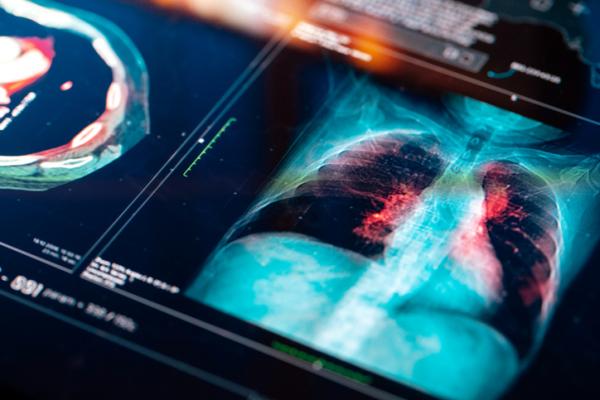 High-dose radiation therapy can be used to lengthen progression-free survival for people with advanced lung cancer when systemic therapy has not fully halted the growth or spread of metastases, according to a new study. 